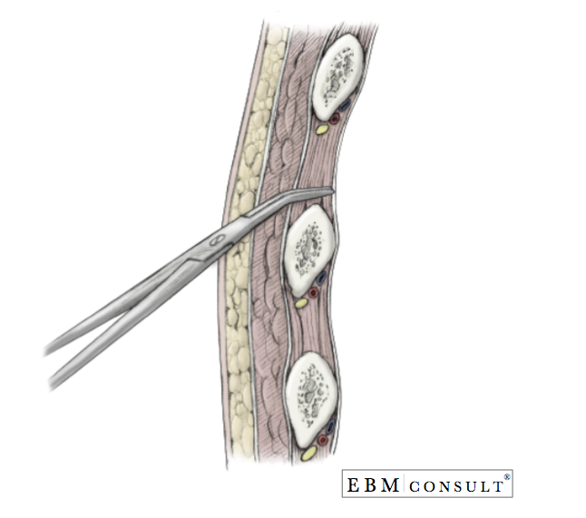 Chest Tube Placement Thoracostomy Procedure